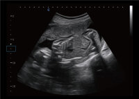 Chison SonoEye