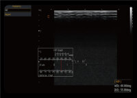 Chison SonoEye